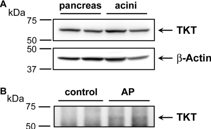 Western blot analysis depicting the expression of transketolase (TKT) in human pancreas and acinar cell samples